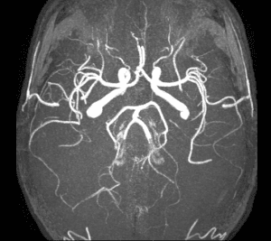 http://www.newgradoptometry.com/wp-content/uploads/2013/11/circle-of-willis-MRI-300x267.png