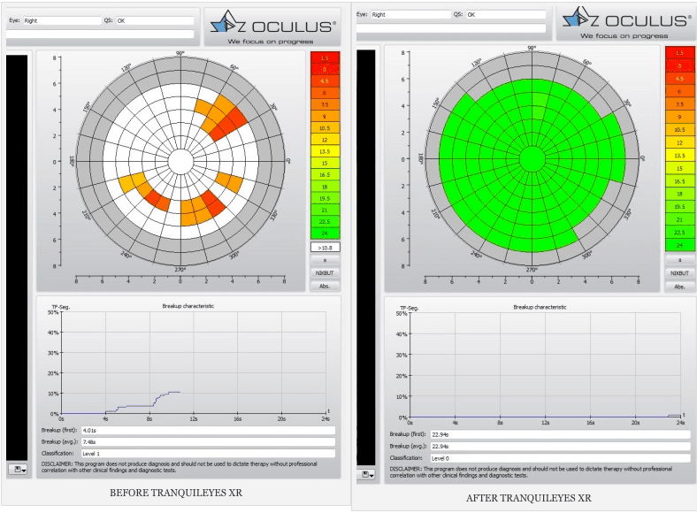 http://www.newgradoptometry.com/wp-content/uploads/2015/03/before-and-after-tranquileyes.png