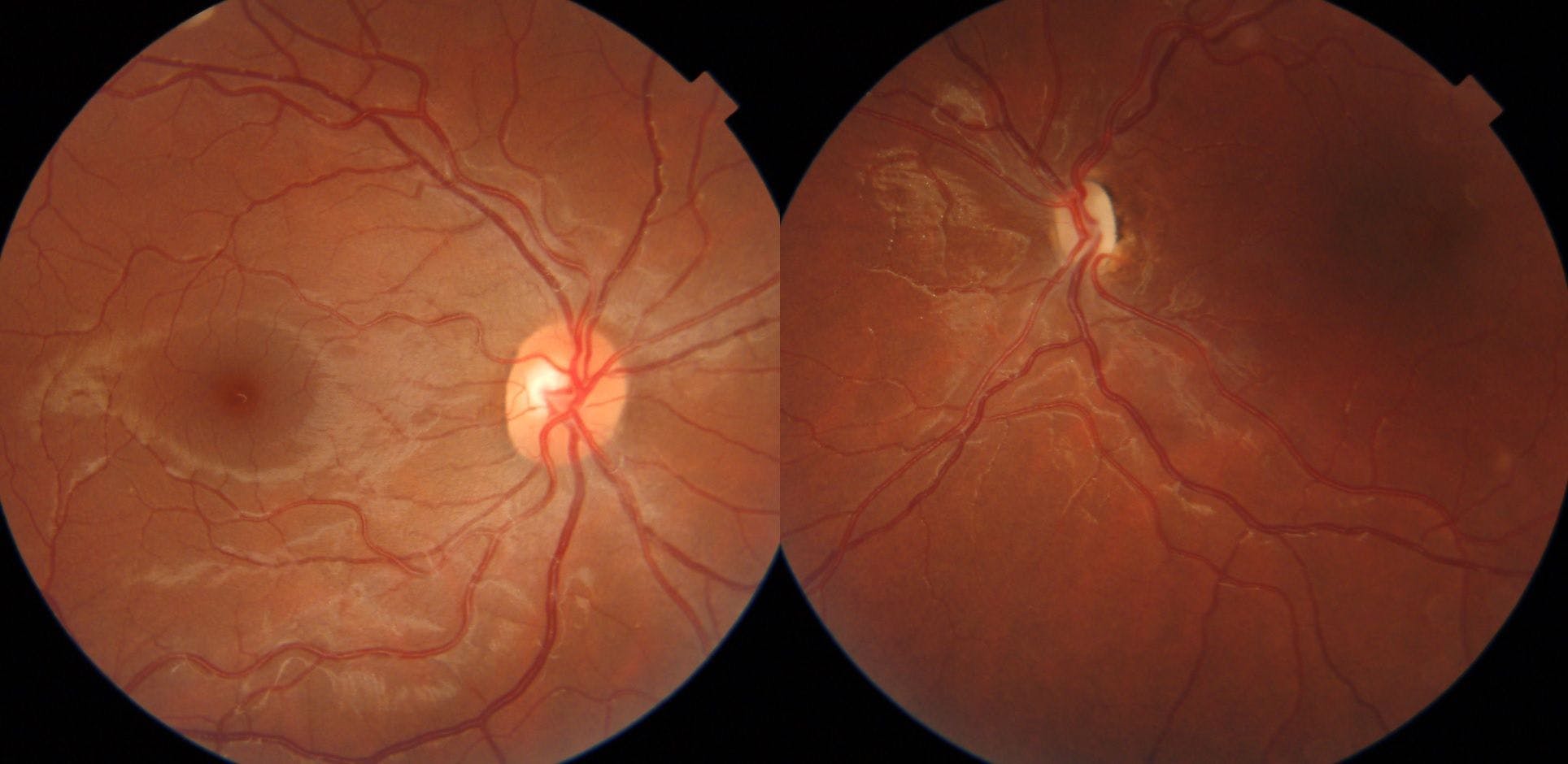 Optic Nerve Hypoplasia Left Eye