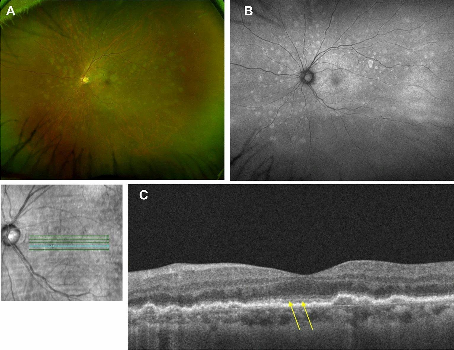 Primary vitreoretinal lymphoma multimodal imaging