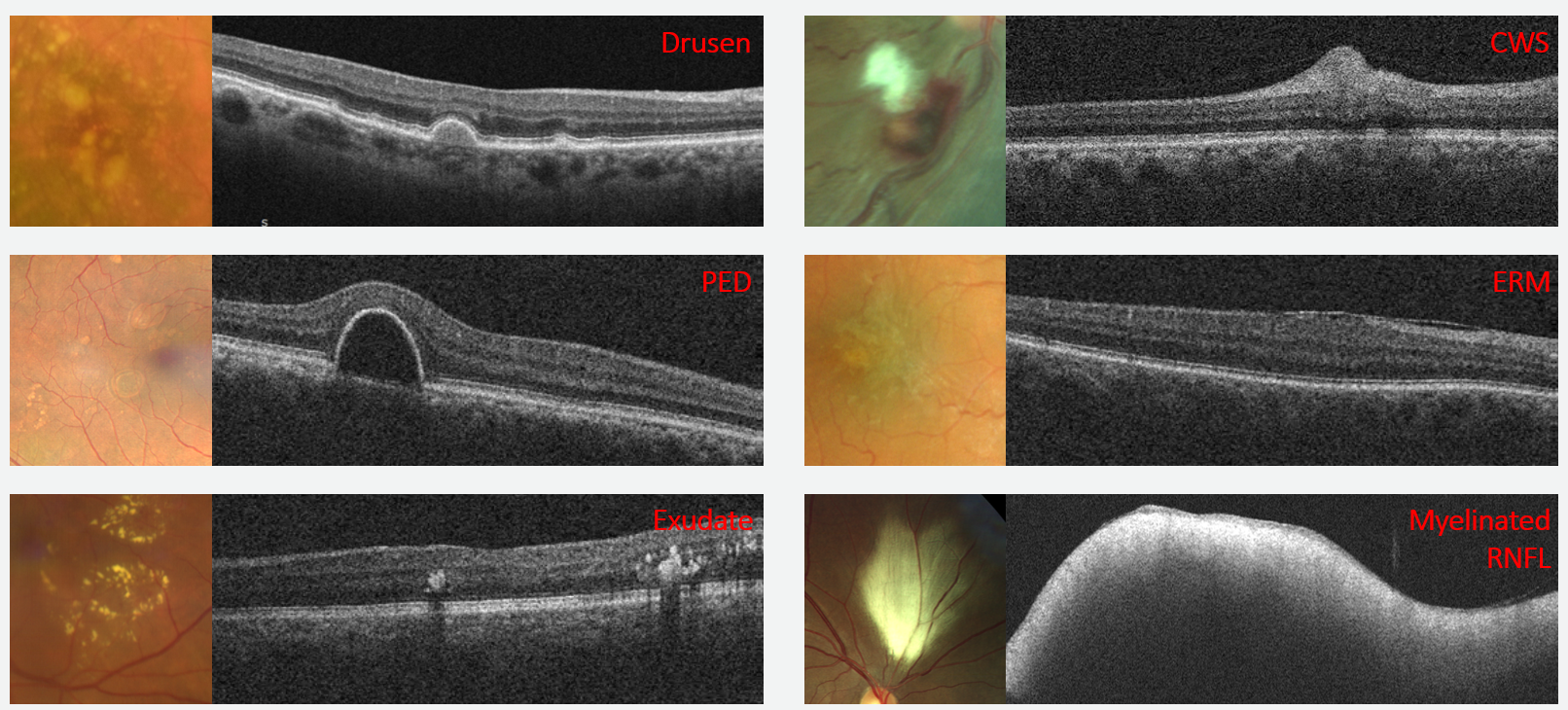 Note the similarities in lesion appearance on the fundoscopic view to the left and B-scan characteristics that easily differentiate the pathology on OCT imaging to the right