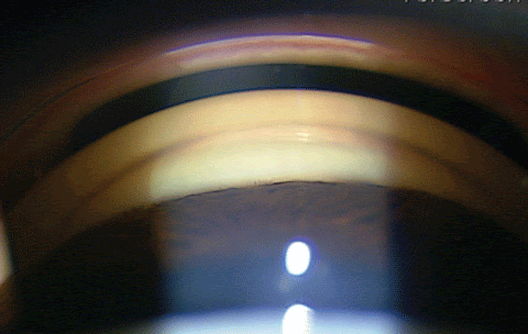 gonioscopy-showing-bare-trabecular-meshwork.gif