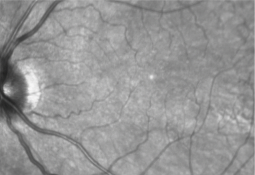 Near-infrared reflectance (NIR) imaging of the patient's left eye from 12 years ago, showing a relatively health retina.