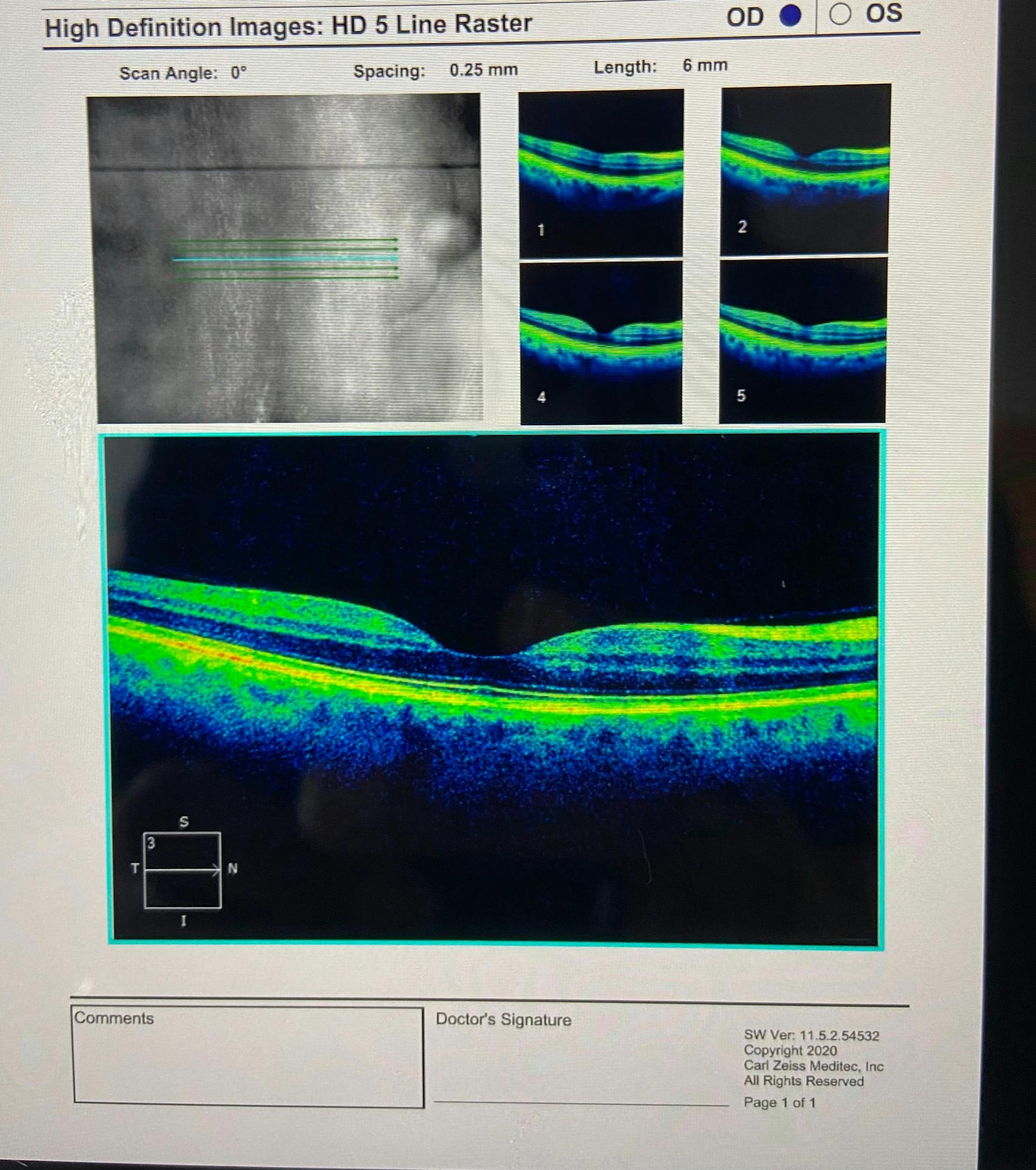 OCT Scan OD