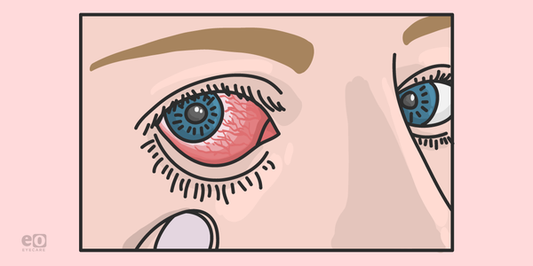 Grading Ocular Inflammation and Uveitis with the SUN Criteria Plus Cheat Sheet