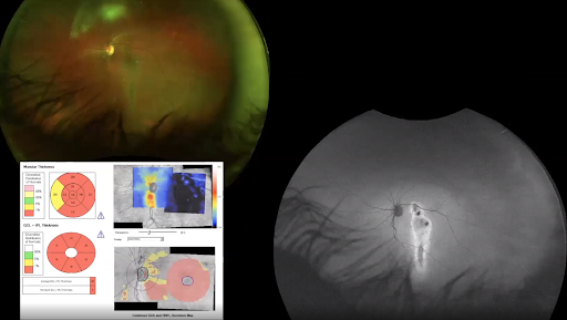 Fundus Photo Damaged Macula