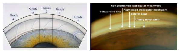 Shaffer-gonioscopy-grading.png