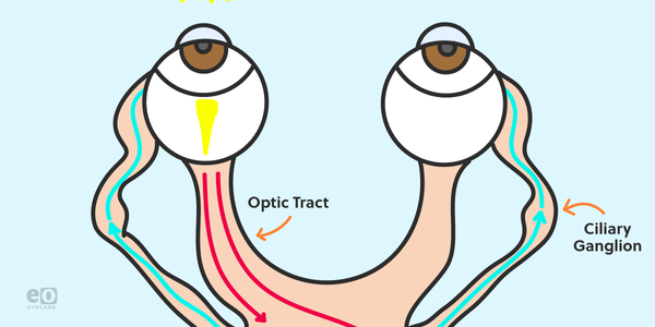 Here's the Easiest Way to Test for an Afferent Pupillary Defect