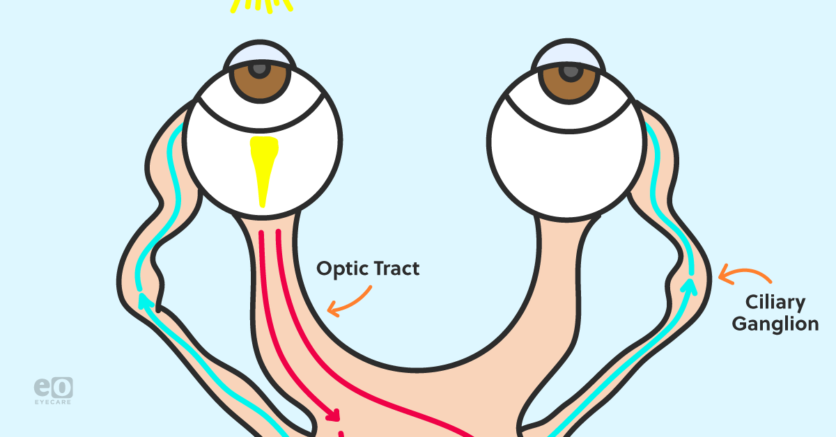 Here's the Easiest Way to Test for an Afferent Pupillary Defect