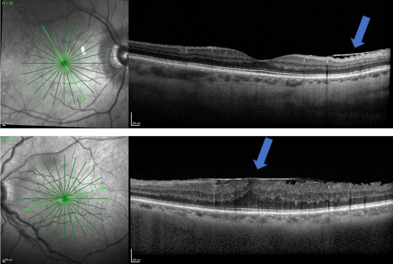 Epiretinal membranes OCT Imaging