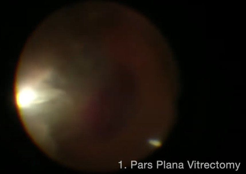 pars plana vitrectomy