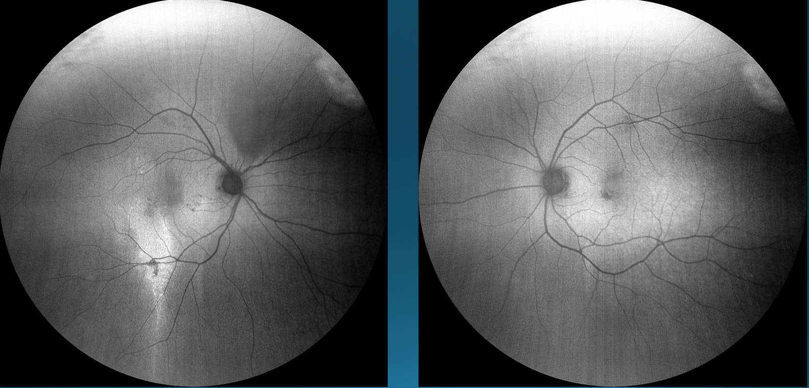 Figure 15: Right eye (left); Left eye (right)