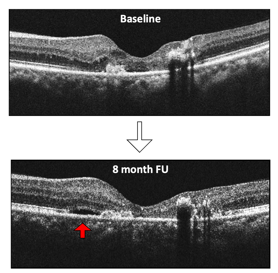 Macular Telangiectasia baseline