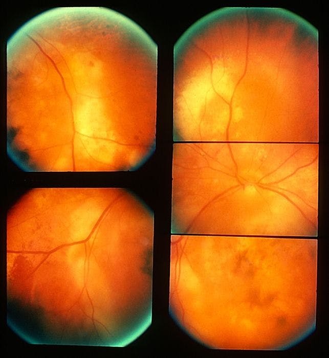 Exudative Retinal Detachment