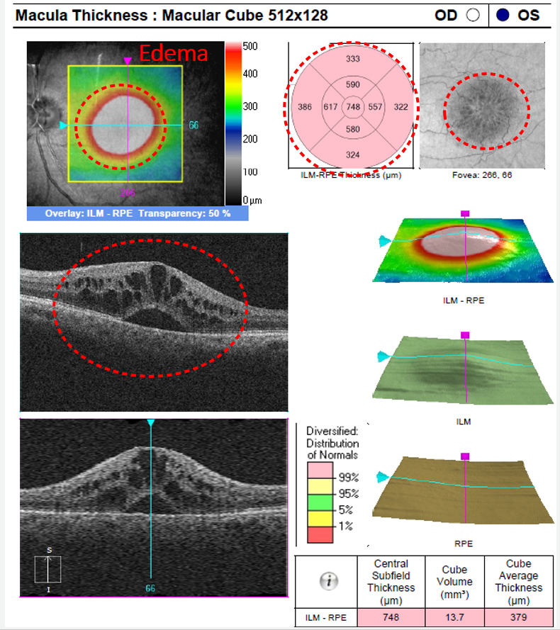 The pataloid shape of cystoid macular edema is well illustrated in the enface image