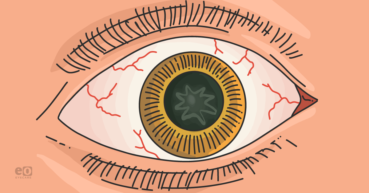 Management of Traumatic Cataracts