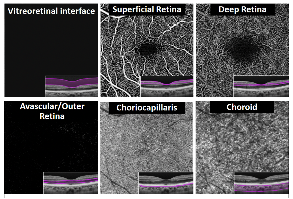 Two-dimensial 6x6mm OCTA map of microvasculature