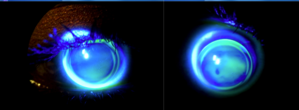 Microcornea lens fitting