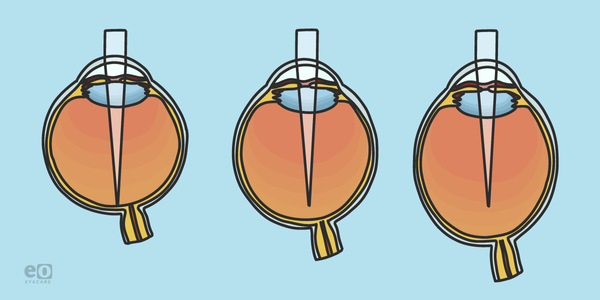 How to Stop Myopia From Worsening