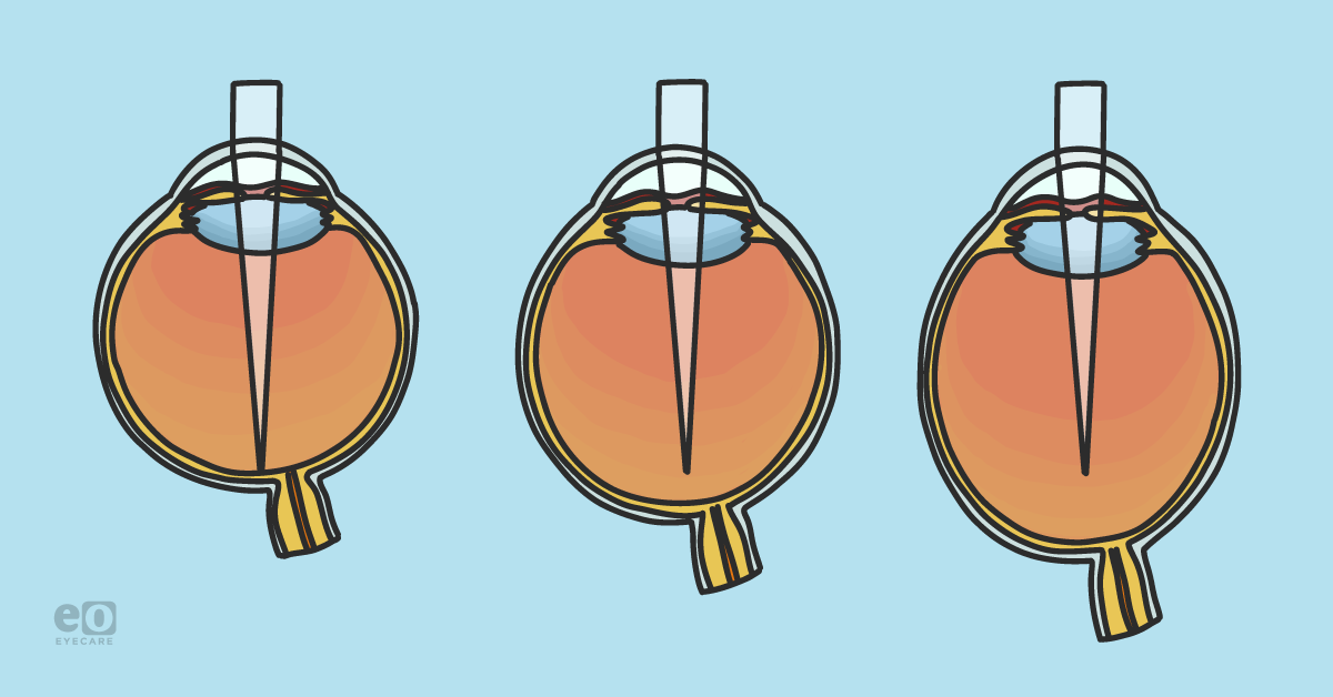 How to Stop Myopia From Worsening