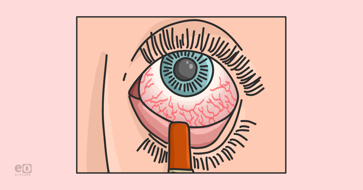 How To Optimize The Ocular Surface Prior to Cataract Surgery