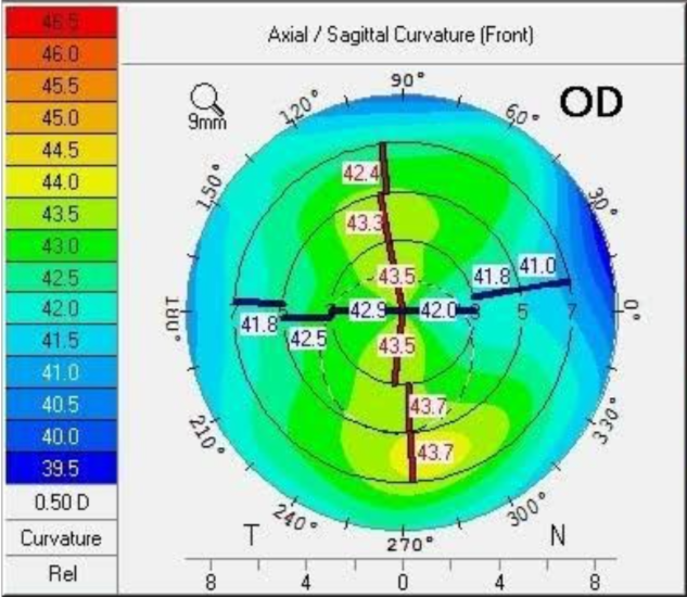 jjv astigmatism figure 2.png