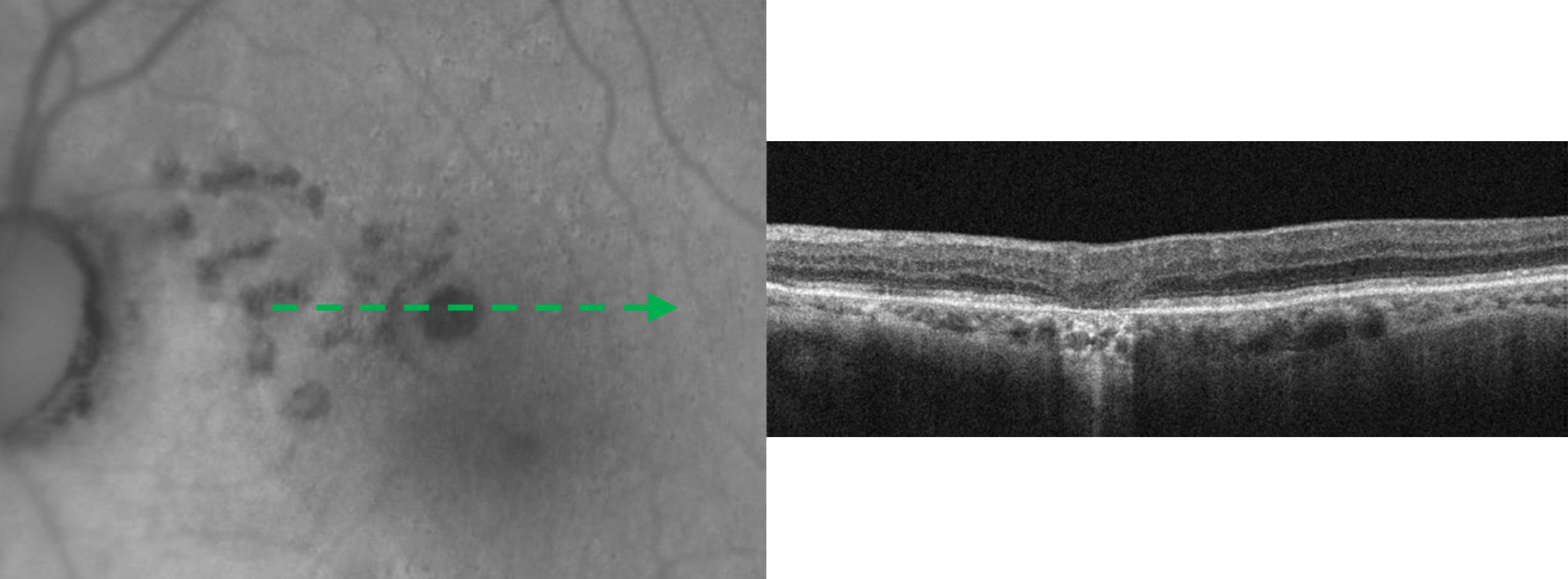 FAF/OCT central atrophy