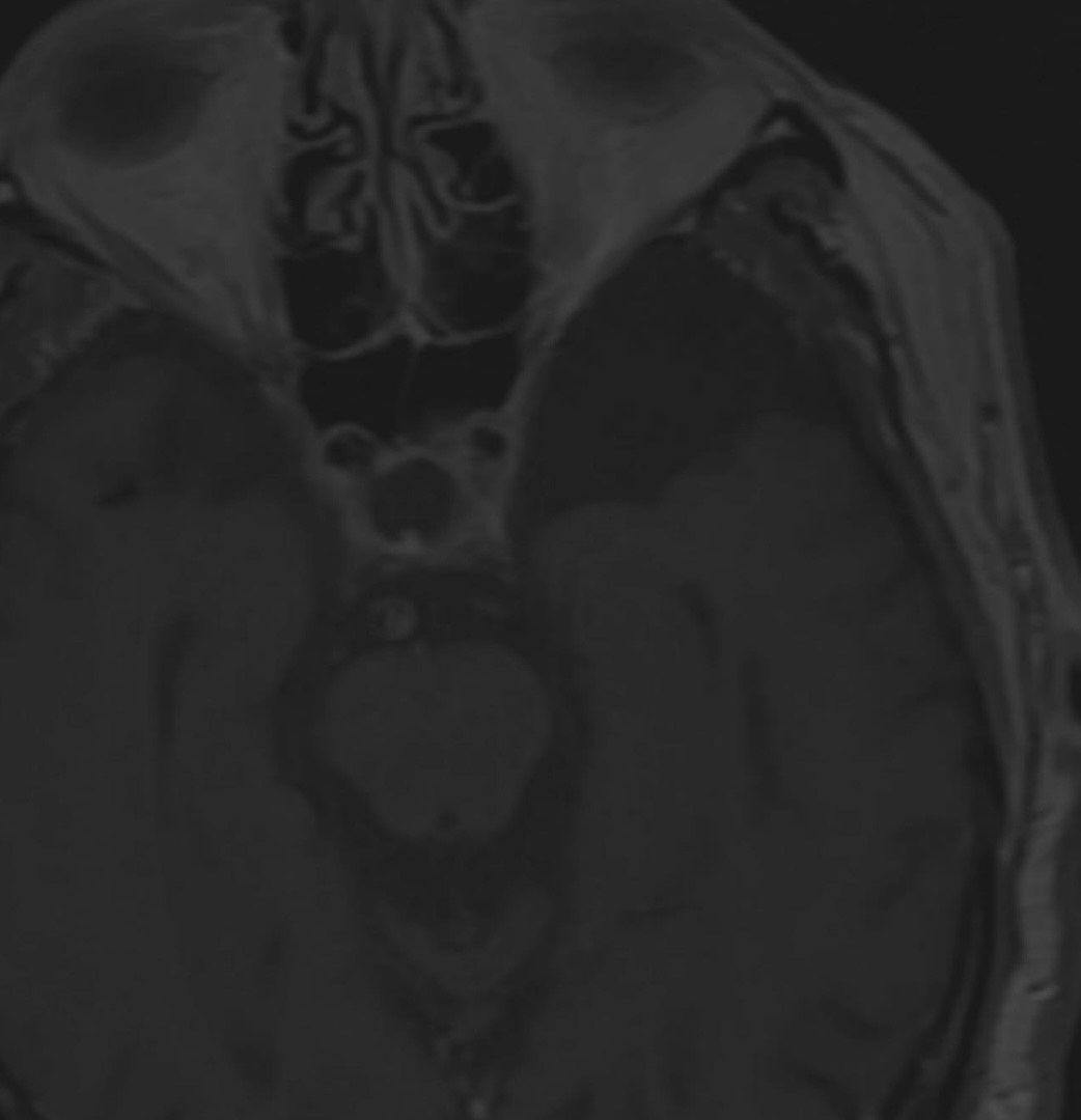 Brain MRI