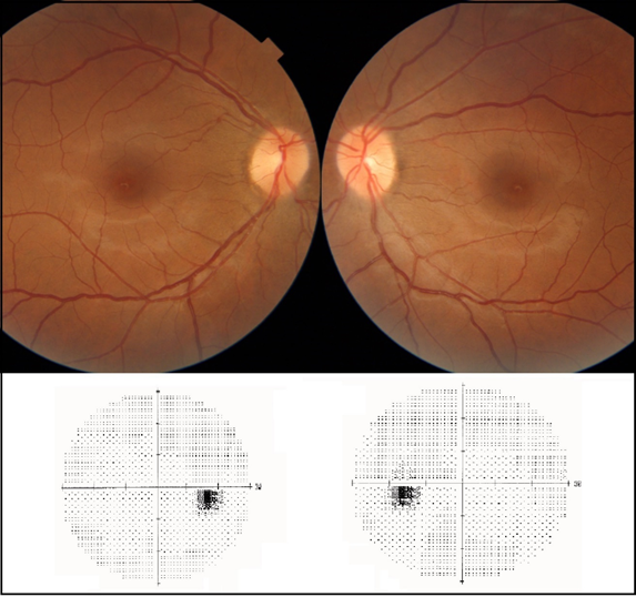 ic hypertension treated