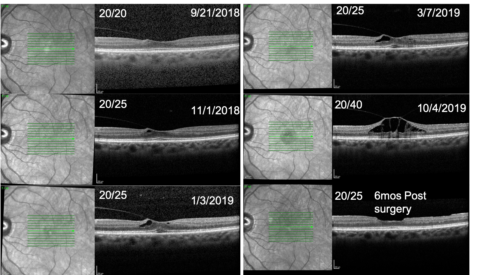 J-Shaped and V-Shaped VMT