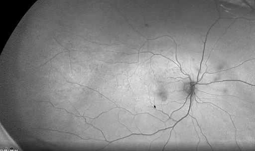 Fundus autofluorescence