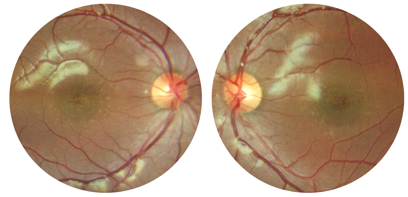 Fundus IRD