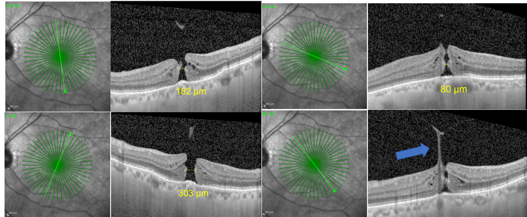 FTMH Radial OCT