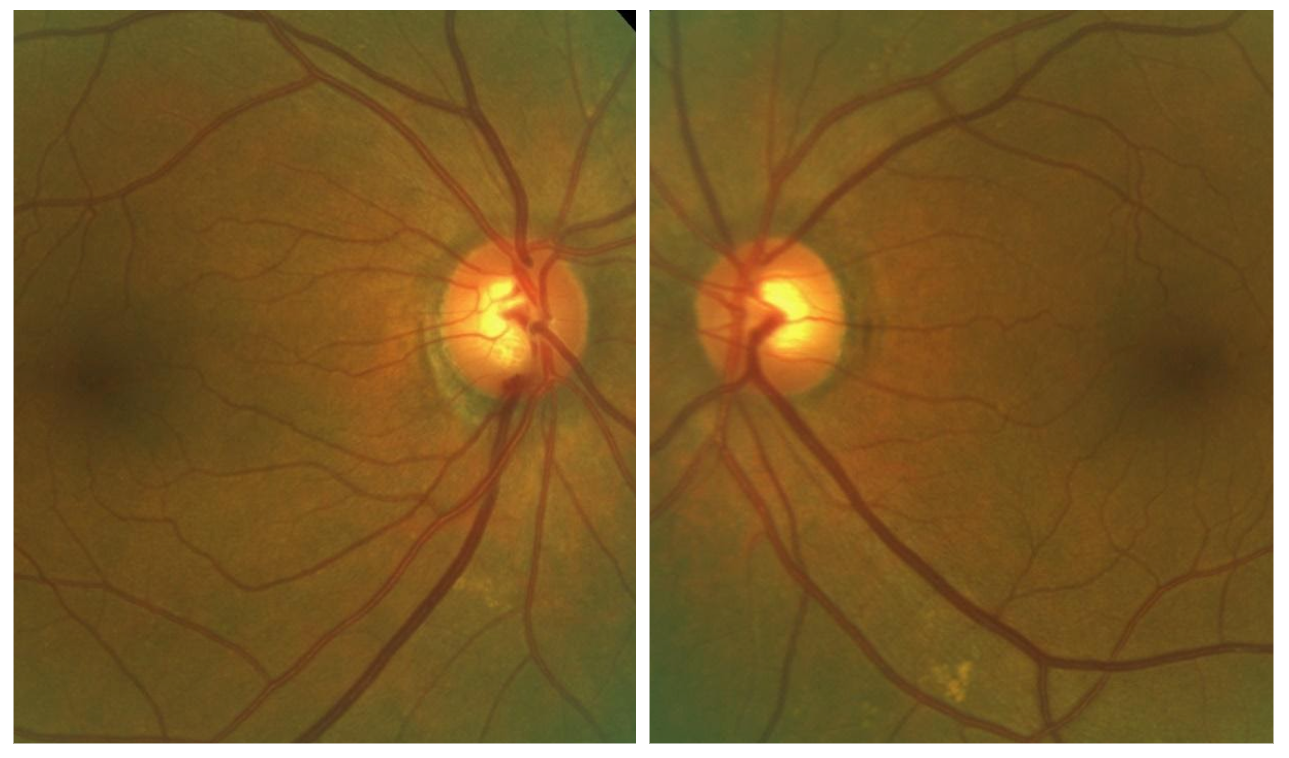 optic disc hemorrhage.png