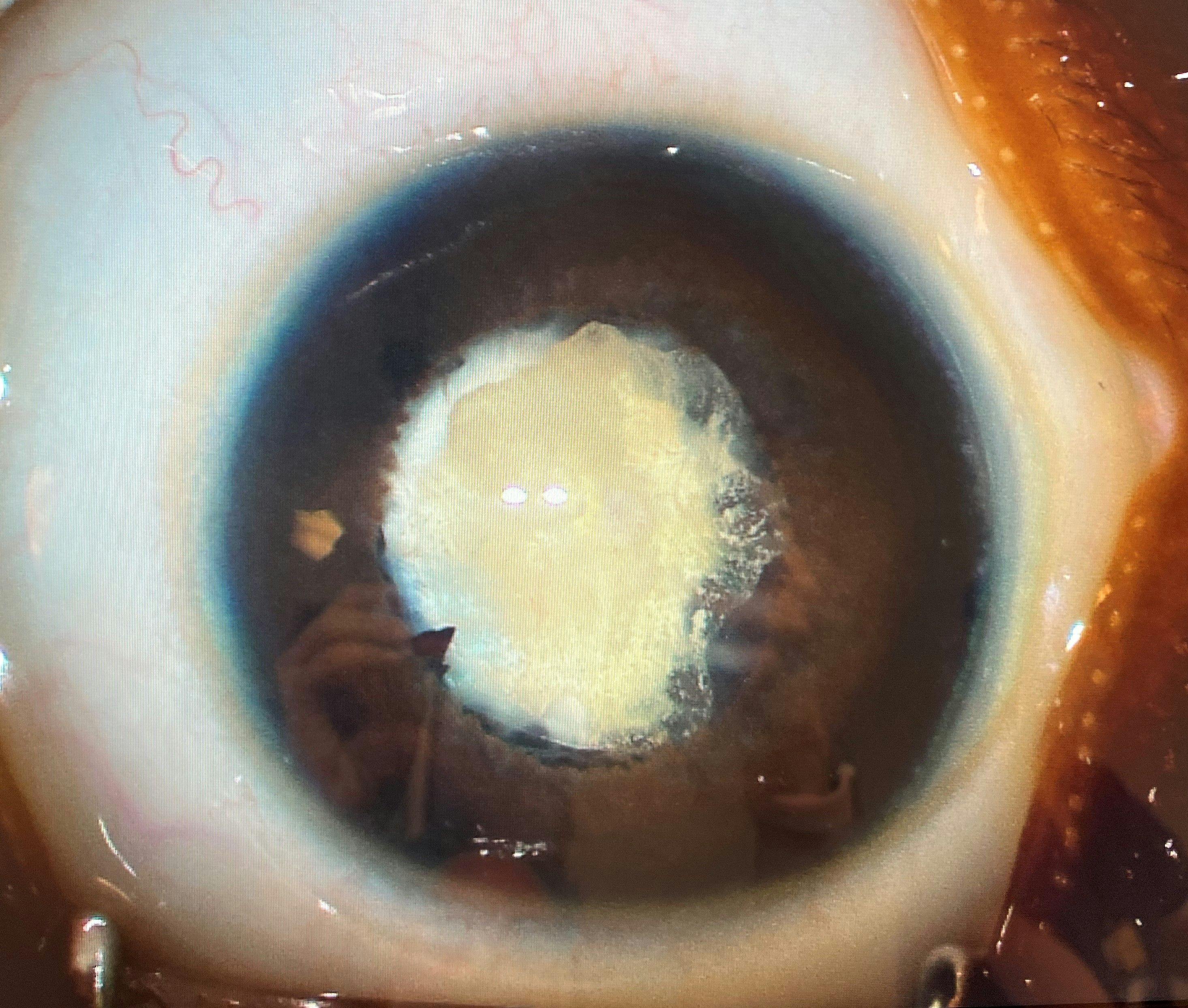 Traumatic cataract