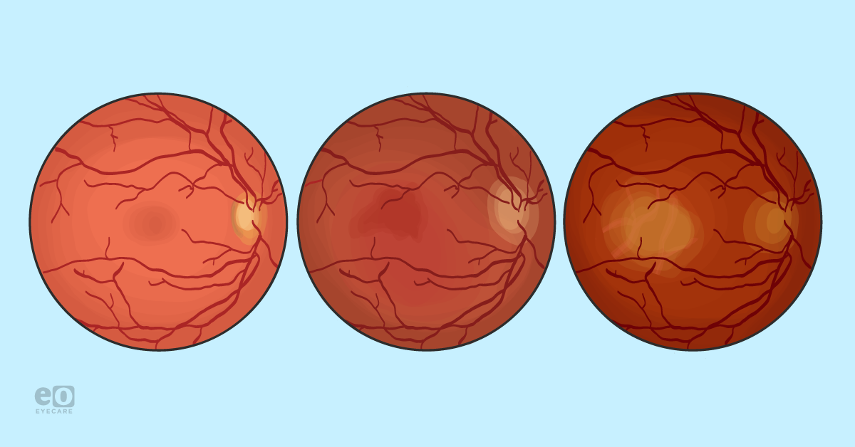 What Macular Degeneration to Geographic Atrophy Progression Really Looks Like