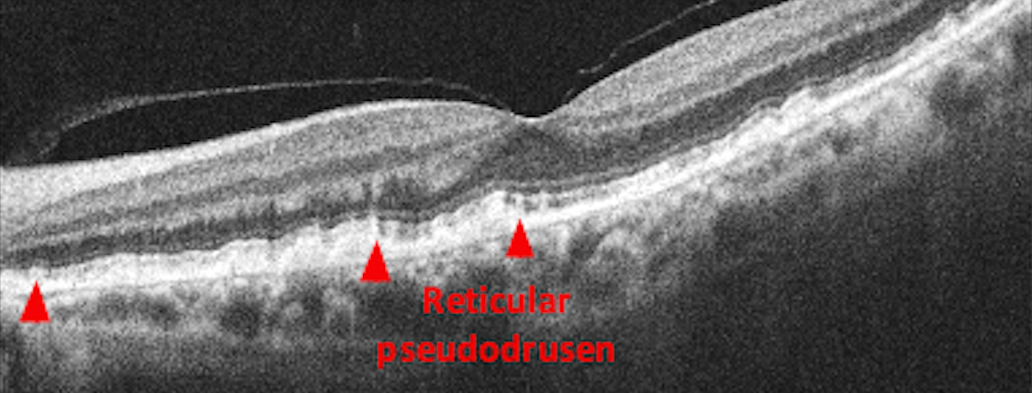 GA OCT Reticular Pseudodrusen