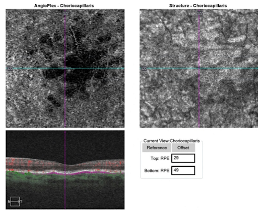 choriocapillarus dry AMD with drusenoid PED