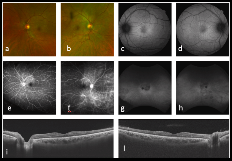 Moderate Vitreitis