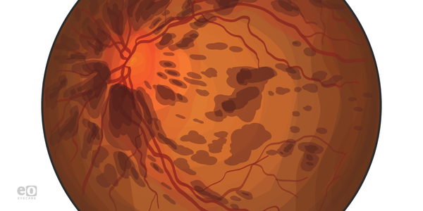 What Ophthalmology Residents Should Know About Flame Hemorrhages