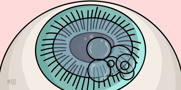 The Ophthalmology Resident’s Guide to DMEK (Descemet Membrane Endothelial Keratoplasty)