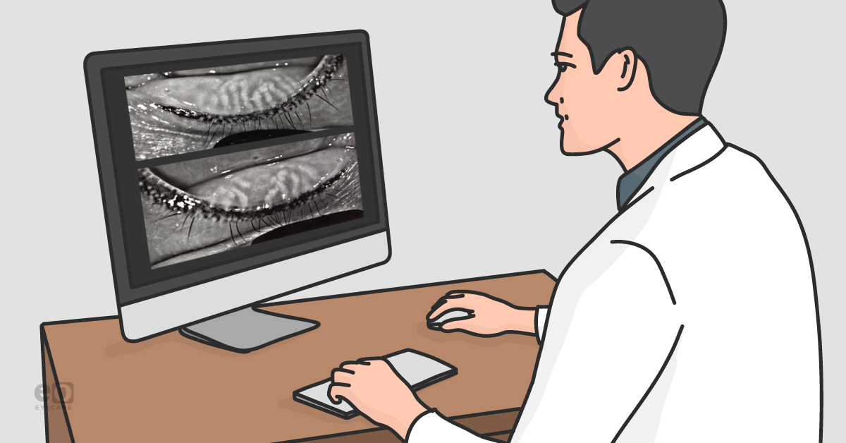 Meibomian Gland Disorder and the Three-Step Treatment