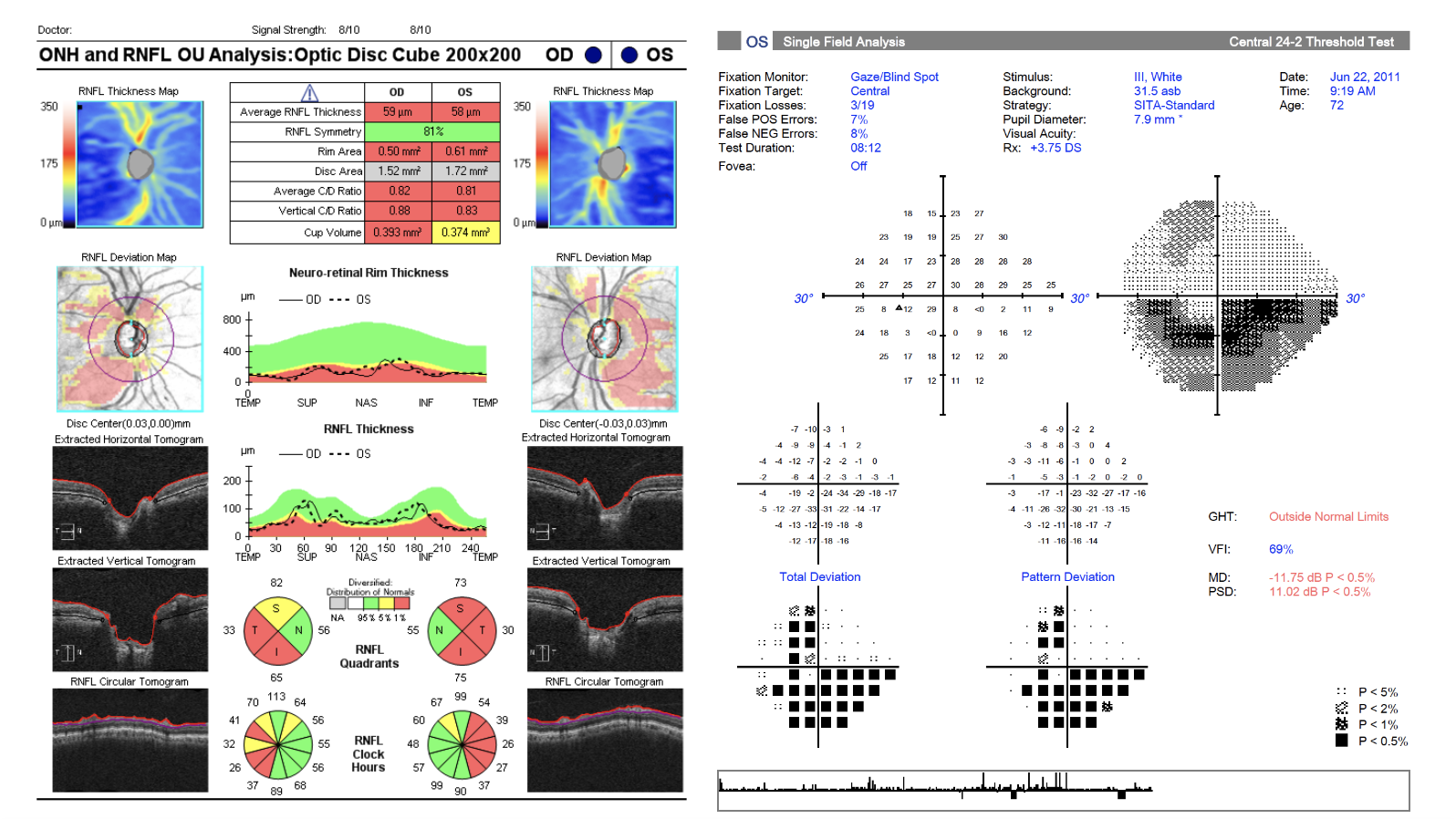 glaucoma progression 2011 OCT patient case 1