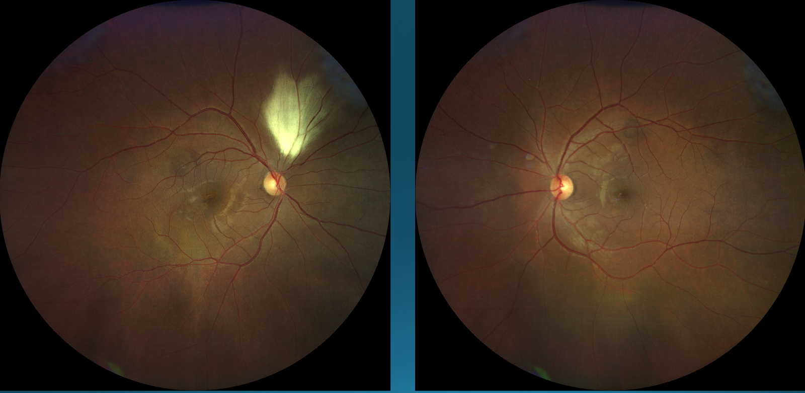 Figure 15: Right eye (left); Left eye (right)