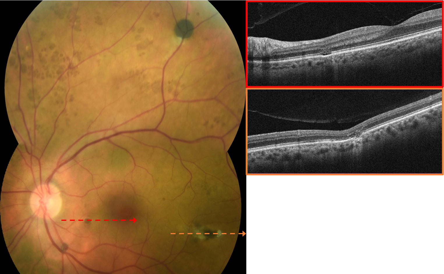 OCT imaging of RPEH-FAP 2