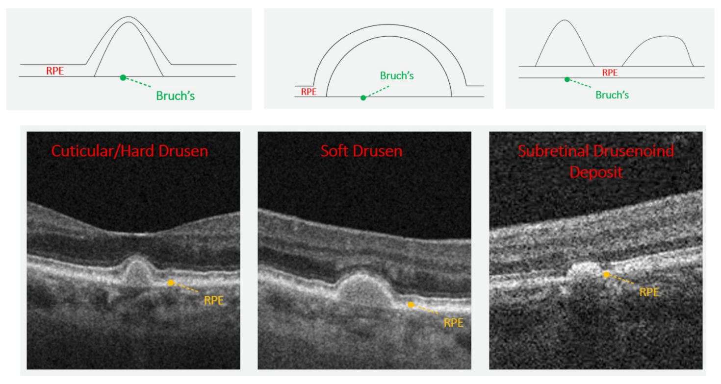 Note the distinct appearance between each drusen type when imaged with OCT