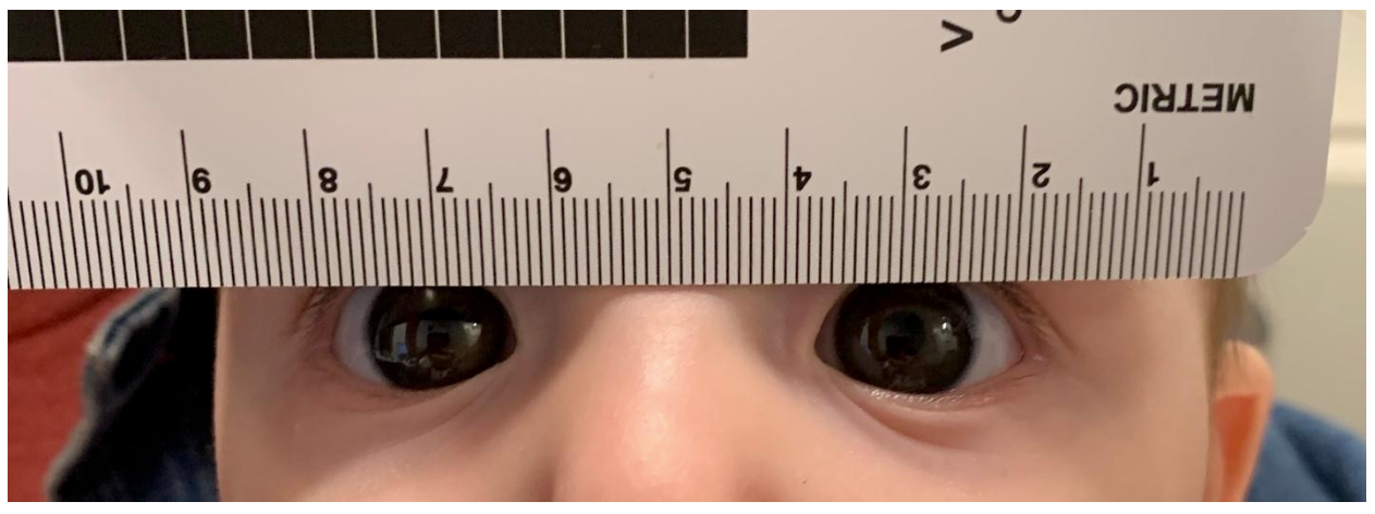 Corneal Diameter