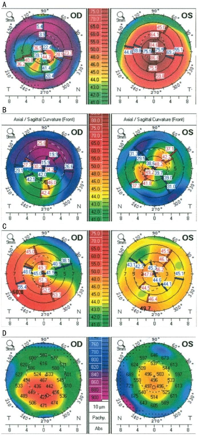 Pentacam Anterior Corneal Curvature Maps