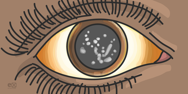 Diagnosing and Managing Granular Corneal Dystrophy