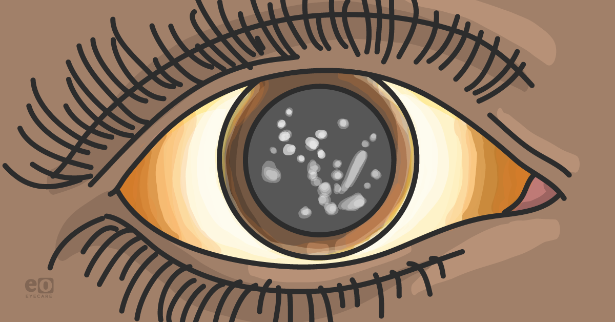 Diagnosing and Managing Granular Corneal Dystrophy